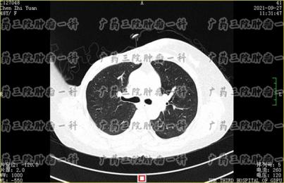 乳腺癌有多少种能治疗?广药三院彭齐荣：这