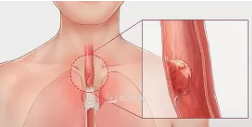 食道癌的真正原因原来是这个