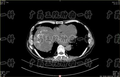 肝癌氩氦刀冷冻消融多少钱一次?