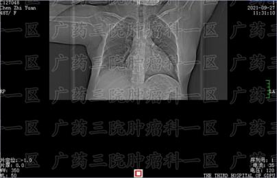 放疗治疗乳腺癌是不是只杀死癌细胞