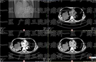 不是所有的癌症患者都能接受化疗