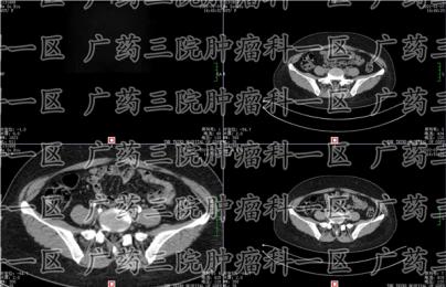 为什么会得子宫癌？